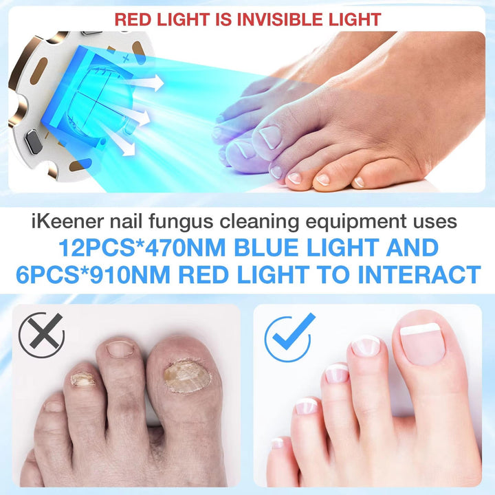 Nagelsvamp Laser