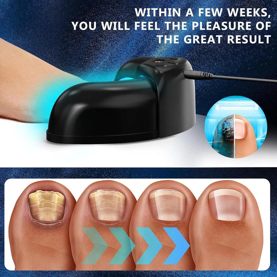 Nagelsvamp Laser