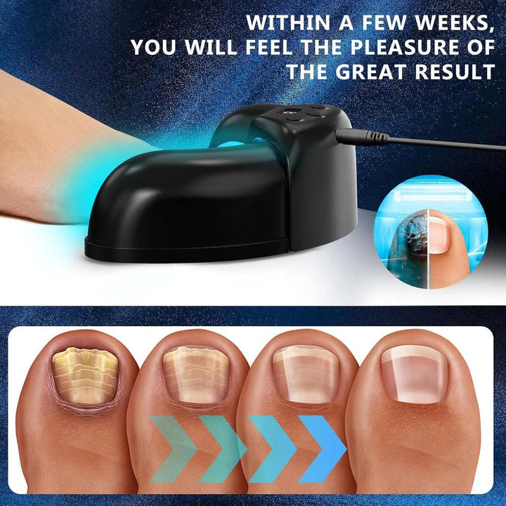 Nagelsvamp Laser