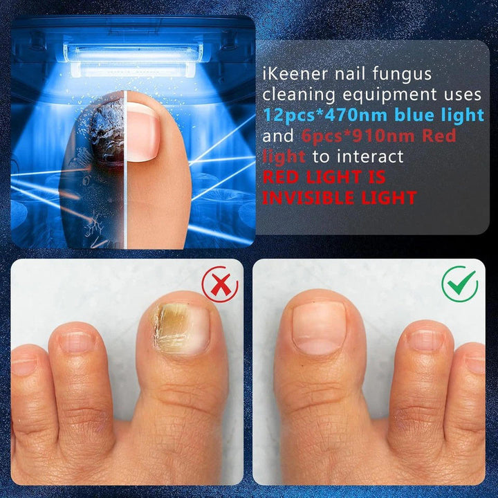 Nagelsvamp Laser