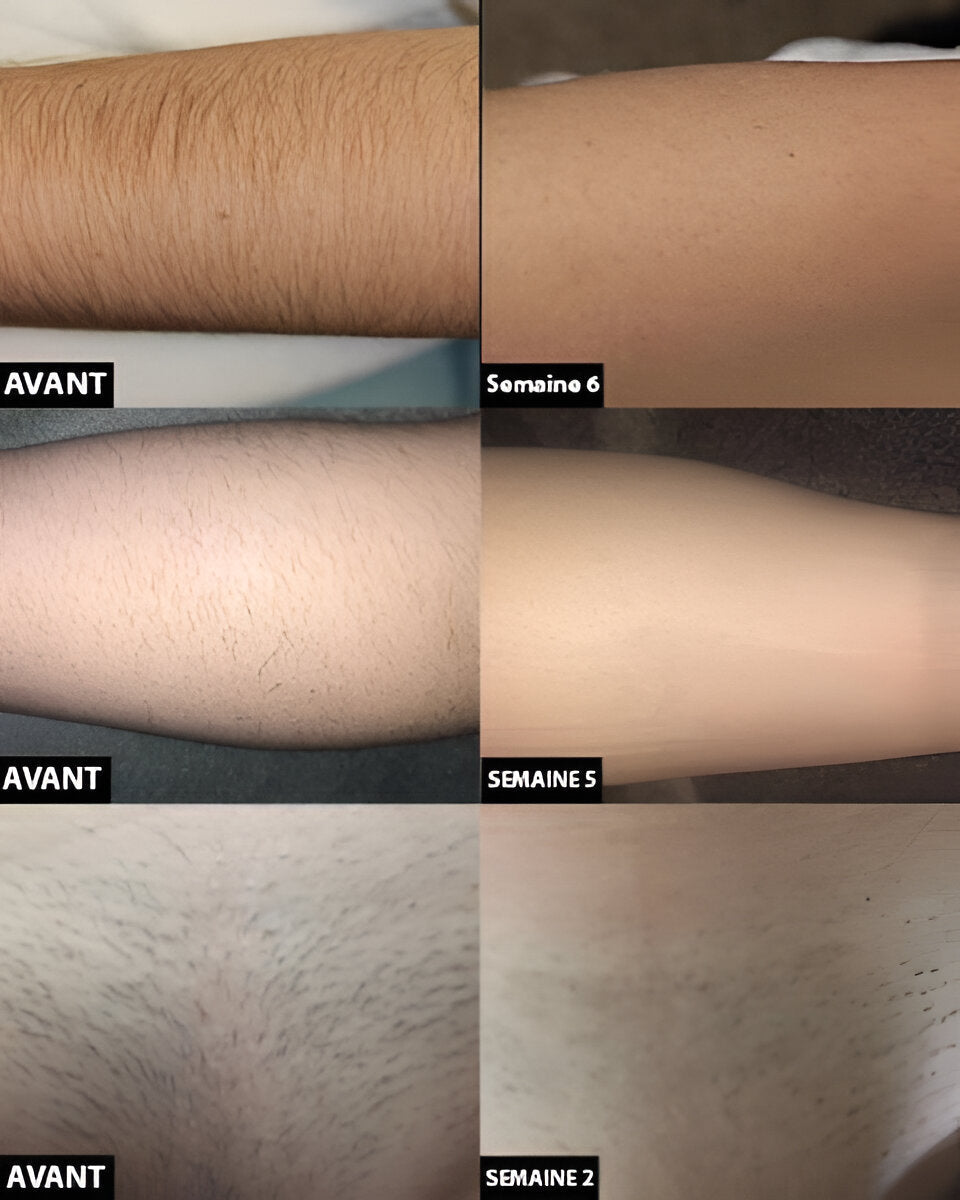Permanent laserhårborttagning