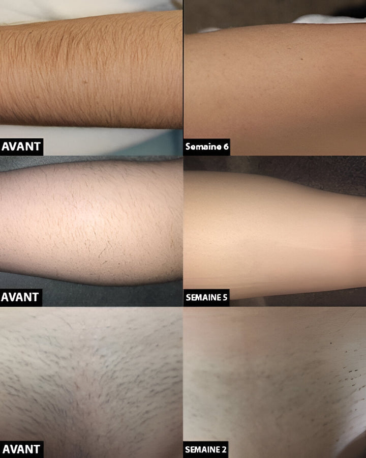 Permanent laserhårborttagning